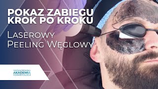 Laserowy peeling węglowy step by step Pokaz  Krok po Kroku  Ogólnopolska Akademia Kosmetologii [upl. by Andaira542]