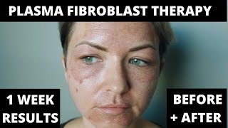 FIBROBLAST treatment experiencebefore and after 7 days [upl. by Noj]