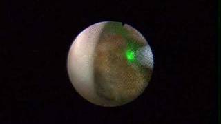 Ureteroscopic laser lithotripsy of kidney stone  Dr Sanjay Razdan [upl. by Tenay]