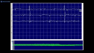 Kimura amp Kohara F21 positive sharp waves and fibrillation potentials each firing regularly [upl. by Polk]