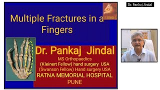 Multiple factors in a small finger Fracture metacarpal  HUND SURGERY  Dr Pankaj Jindal [upl. by Rivers]