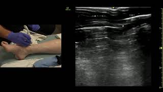 Ultrasound of the Ankle Joint Anterior Approach [upl. by Utley282]