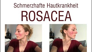 Wie ich meine Rosacea geheilt habe  LaserTherapie [upl. by Knorring]