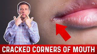 What Causes Cracked Corners of Mouth amp How to Get Rid of Angular Cheilitis – Dr Berg [upl. by Anitnoc]