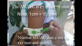 IMCI Measuring Mid Upper Arm Circumference MUAC [upl. by Kylstra683]