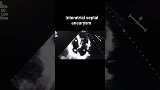 Interatrial septal aneurysm [upl. by Mayrim623]