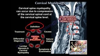 Cervical Myelopathy  Everything You Need To Know  Dr Nabil Ebraheim [upl. by Etem625]