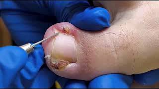 DIY Ingrown Toenail Removal  How to Safely Cut Ingrown Toenails at Home [upl. by Pardner]