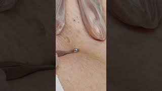 Effective Ingrown Hair Removal  Watch the Transformation [upl. by Wash]