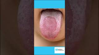 Treatment for Geographic Tongue and 4 Best Practices [upl. by Nella]