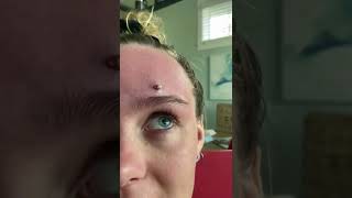 Cystic Acne Extractions Whiteheads  Blackheads Removal Today [upl. by Icak904]