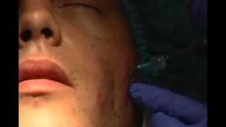 Aumento de pómulos mejillas y recuperación del contorno facial  Tratamiento Facial [upl. by Leopoldine221]