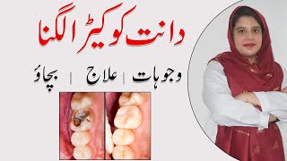 Dental Caries  Tooth Decay Cavity  Causes Symptoms Treatment  Daant Mein Keede Ka Ilaj [upl. by Nowtna]