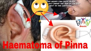 Haematoma of auricle Hematoma of pinna ear emergency with signs  symptoms amp treatmentMedic Surgi [upl. by Sherourd]