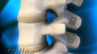 coflex motion spine [upl. by Nord]