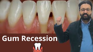 Signs of Receding Gums  How to stop gum recession [upl. by Marylin]