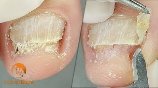 2 cases 1 video XI  1 Onychomycosis  2 Onychogryphosis Podological treatment [upl. by Eiralav]