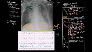 Insuffisance cardiaque aigue  Partie 2  Docteur Synapse [upl. by Greenlee]