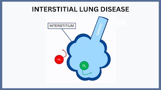 Interstitial Lung Disease Explained [upl. by Anitneuq]