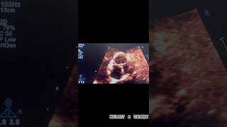 Aortic regurgitation assessment in echo phonk 123sonography heartandtechy echocardiogram [upl. by Florin]