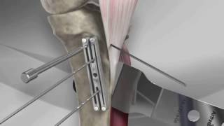 Tibial Tubercle Osteotomy [upl. by Eatnahs]