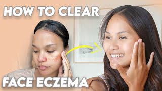 Get Rid of Facial Eczema lifechanging tips [upl. by Leonard]