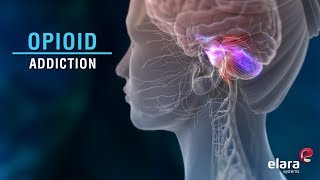 What is Opioid Addiction Animation Video Answers the Question [upl. by Diad303]