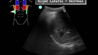 POCUS  Teaching Point  Ultrasound vs CXR in pneumonia [upl. by Assetak181]