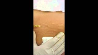 Video Trattamento Smagliature con NANOFAT Lipostruttura LondeiClinic [upl. by Belia192]