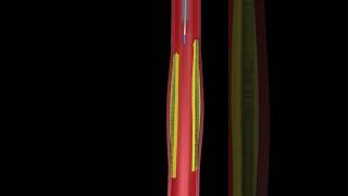 Animated angioplasty Explained in 3D  Watch the Procedure [upl. by Brubaker]