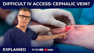 Difficult IV access Cephalic Vein [upl. by Hanus993]