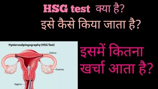 HSG test in Hindi  HSG test Procedure and cost in Hindi [upl. by Yecnahc250]