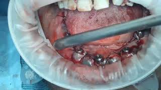 live  part 2  all on 5 with SMU Implants in atrophic mandible [upl. by Reinert216]