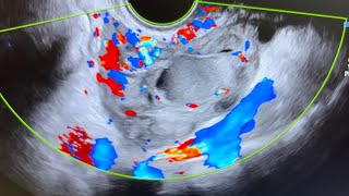 Ultrasound of acute salpingitis thick vascular fallop tube endometriotic simple amp nabothian cyst [upl. by Paula]