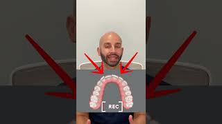 How we make space to straighten overlapping front teeth with Invisalign instead of metal braces [upl. by Eednil]