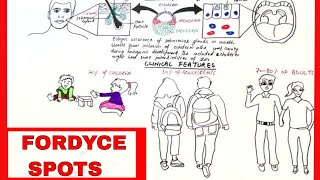 Fordyce Spots  Pathophysiology Clinical Features amp Treatment [upl. by Duffie836]