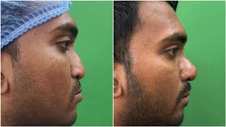 Rhinoplasty Results  Binders Syndrome Nose Deformity  Dr Jayanta Bain Plastic Surgeon [upl. by Nospmoht]