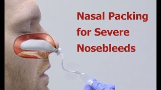 Nasal Packing for Severe Nosebleeds [upl. by Agnot861]