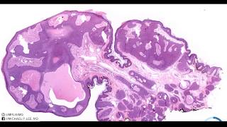 Eccrine Poroma with a twist hybrid acrospiroma explained by a dermatopathologist unknown 11 [upl. by Chak]