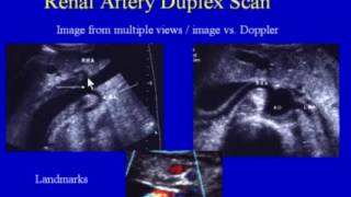 Renal Artery Duplex Scan [upl. by Shutz]