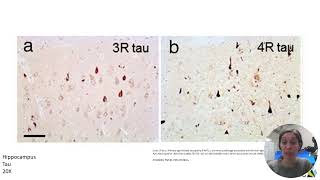 Neuropathology  Part 2 [upl. by Ahsaya]