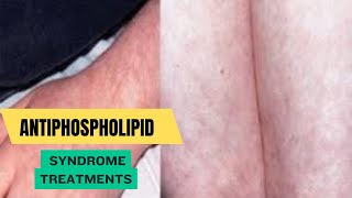 Antiphospholipid Syndrome Treatments [upl. by Aehs]