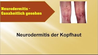 Neurodermitis der Kopfhaut  GANZMEDIZIN Naturheilpraxis [upl. by Gnoc548]