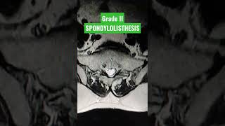 Grade II Anterior Spondylolisthesis of L5 over S1 vertebra viral youtubeshorts mri shortsfeed [upl. by Esinel211]