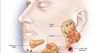 salivary gland tumors [upl. by Godspeed]