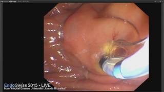 EndoSwiss 2015 LIVE case ERCP wih biliary sphincterotomy and stenting for palliative purpose [upl. by Jann]