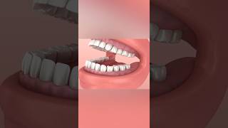 Wisdom tooth problem dentist teeth [upl. by Anema]