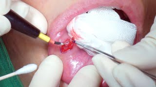 mucocele lip removal surgery HD 입술 점액낭종 제거 수술  수원 광교 유디트 성형외과 [upl. by Edla]