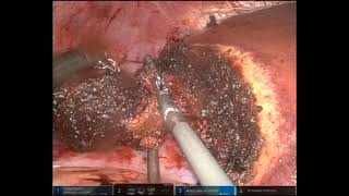 Simultaneous Robotic Right Colectomy with Intracorporeal Anastomosis and Partial Hepatectomy [upl. by Ahcsropal]