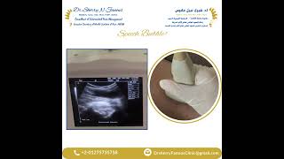 Speech Bubble or Bakers cyst Ultrasound Scan [upl. by Rimola]